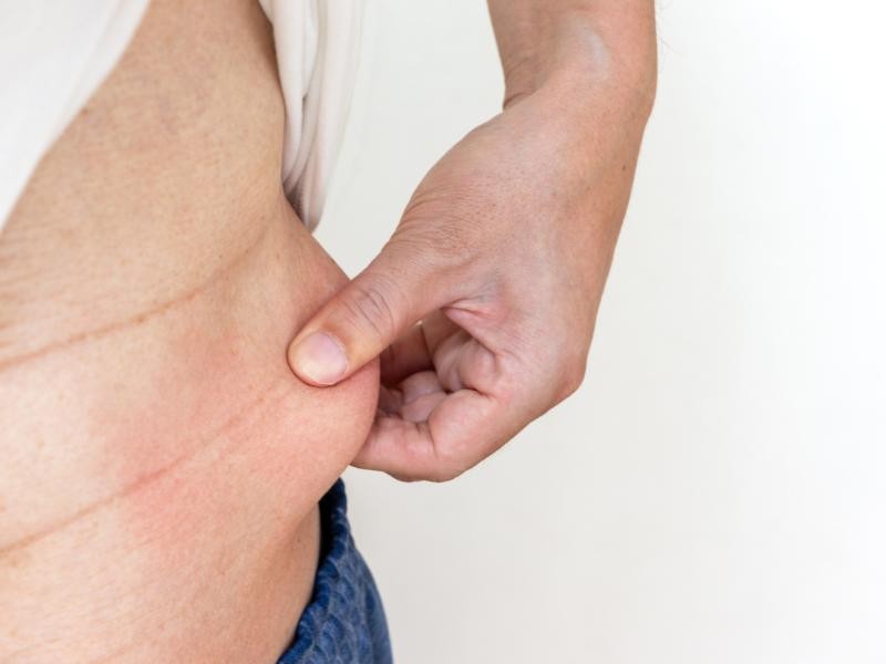 ✨ Anidro X (Carboxiterapia) Contra a Flacidez: Como Funciona na Firmeza da Pele