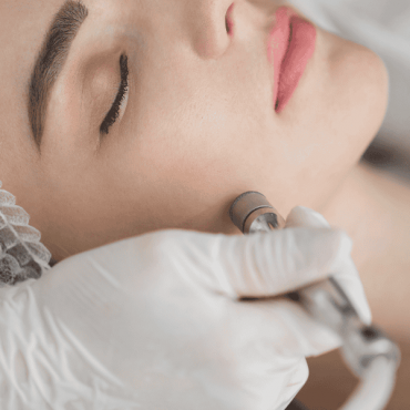 Peeling de Diamante em Barão do Triunfo