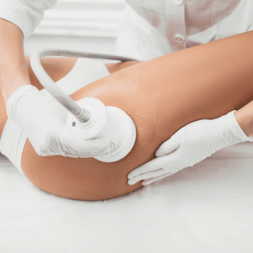 Tratamento para Celulite em Barão do Triunfo