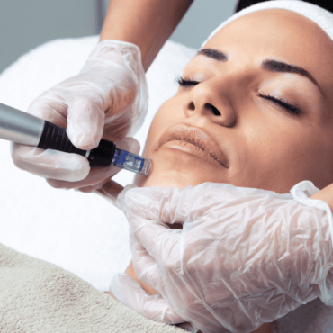 Microagulhamento em Barão do Triunfo