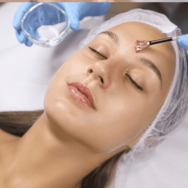 Peelings Químicos em Barão do Triunfo