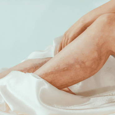 Tratamento para Lipedema em Barão do Triunfo