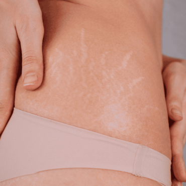 Tratamento para Estrias em Barão do Triunfo