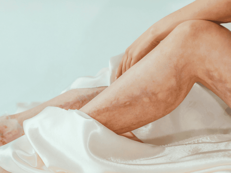 Tratamento para Lipedema